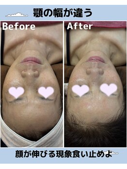 カシェボーテ(CACHE BEAUTE)/EMSで小顔とリフトアップ