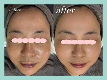 ミウル 天王寺店(miulu)/50代/シミケア照射＋ハーブ4回目