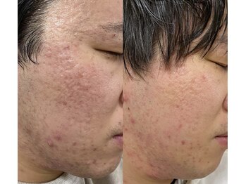 アネモネ(ANEMONE)/プロセルフェイシャル