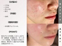 ルディラ医療提携エステ 立川店 毛穴/小顔/ニキビ・シミ・美白・シワ・たるみケア/水光肌フェイシャル