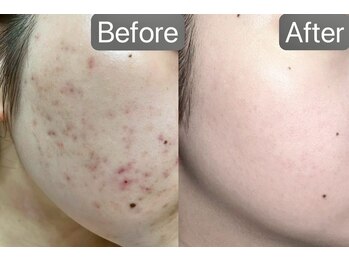 ベル 静岡(Belle)/静岡/ハーブピーリング/毛穴