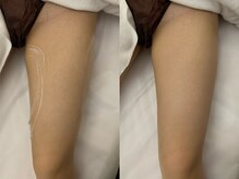 ナラビューティー(NARA BEAUTY)/内もも外もも恵比寿1回