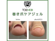 ボニータ(BONITA)/巻き爪ケア