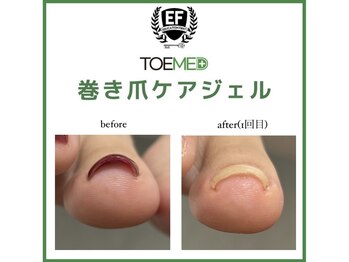 ボニータ(BONITA)/巻き爪ケア