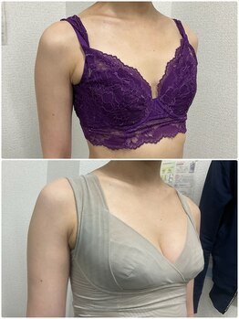 バーディー(BIRDIE)/施術５カ月/４０代/B→Dカップ