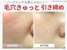 【毛穴引き締め】まるで陶器肌◎肌質別美容液入りハーブピーリング　¥11000