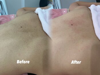 クイーン 渋谷店(QUEEN)/上半身ケアも