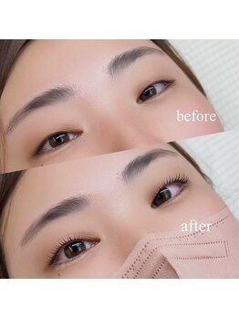 アン(anne)/before ・after