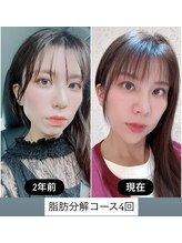 リジュベネ(rejuvena)/【最新脂肪分解で驚きの効果！】