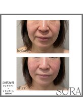 青空 天神大名店(SORA)/オンダリフト×レモンボトル１回