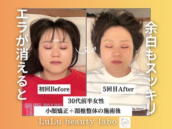 ルルラボ(LuLu beauty labo)/エラ改善で余白スッキリ☆
