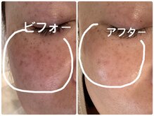 ノーブル シャット Noble Chate/シミ・くすみが気になる方へ