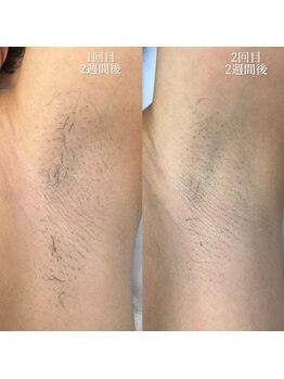 モワメーム(moi meme)/全身美肌脱毛【ワキ/脇脱毛】