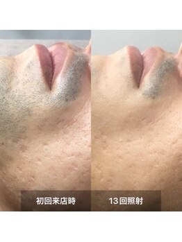 リムル(REMURU)/ひげ脱毛13回照射