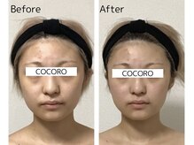 ココロ(COCORO)/お顔のむくみならコルギ