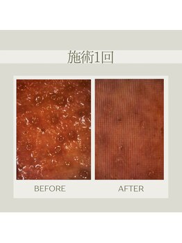 グラサヴォーグ 金沢店/毛穴カメラ施術1回の変化