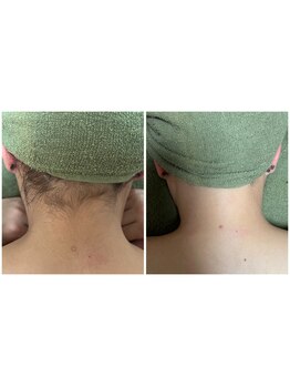 隠れ家エステサロン ミンピ(Mimpi)/うなじ背中脱毛