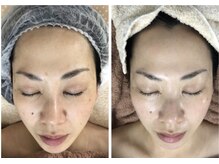 アルページュ(Arpege)の雰囲気（リアボーテハーブ水滴LDM#ニキビケア#シミケア#筋膜調整#肌育）