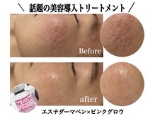 ブレア(Blair)の雰囲気（20代お客様  毛穴の凸凹〈エステダーマペン×美肌成分導入〉5回）