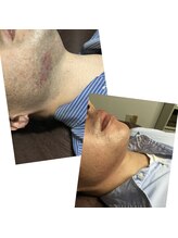 ダンディラボ(Dandy Lab)/髭脱毛ビフォーアフター