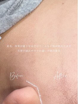 キスミー(Ksmiii)/フェイスワックス　WAX脱毛