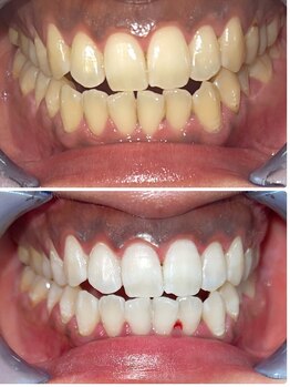 ココホワイトニング 天王寺店/ビフォーアフター6