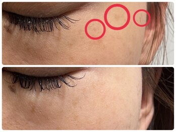 ミニョン(mignon)の写真/レーザー不要シミケアを体験してみませんか☆シミケアでお肌を整える丁寧なケアを。