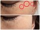 ミニョン(mignon)の写真/レーザー不要シミケアを体験してみませんか☆シミケアでお肌を整える丁寧なケアを。