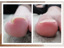 ルポ(REPOS)/巻き爪ケア