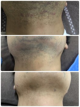 シア 静岡店(cia)/【ヒゲ脱毛】