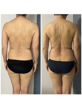 モア(moa)/たった2回でこの変化！