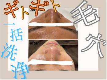ア クイーユ(Accueil)/ギトギト毛穴スッキリキレイに!