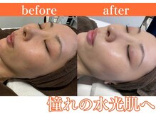 パールホワイトニングサロン 小田原店/韓国肌管理/ララピール人気！！