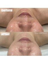 ランタン(Lantern)/ACトリートメント