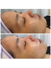 ココロニコル 今治店/フェイシャルwax