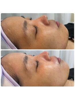 ココロニコル 今治店/フェイシャルwax