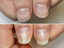 グラシュータン(gracieux temps)/深爪矯正