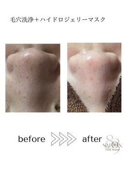 サロン エイトミー(salon 83)/毛穴洗浄/before→after