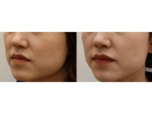 ファミリアくわな鍼灸院/ビフォーアフター/９回目