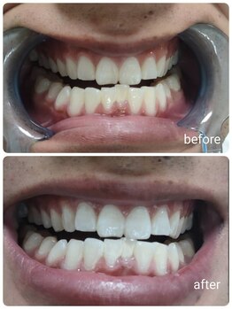 セルフホワイトニングサロン　エクシアホワイトニング　錦糸町店/ホワイトニングビフォーアフター