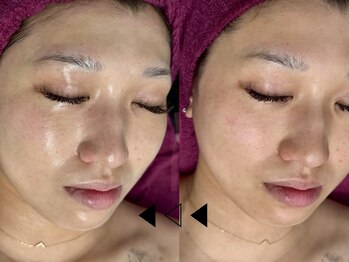 バタフライ 津田沼店(Butterfly)/Butterflyのハーブピーリング!