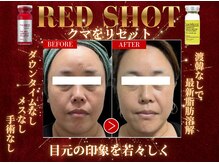 モテ美白の雰囲気（眼窩脂肪によるクマをリセット）