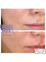 エリス(ELISSE)/口周の産毛もスッキリ！