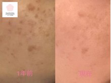 サクラ(SAKURA)/シミ/たるみ/フェイシャル/小顔