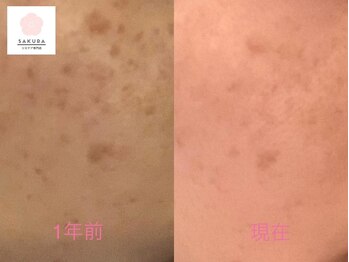 サクラ(SAKURA)/シミ/たるみ/フェイシャル/小顔