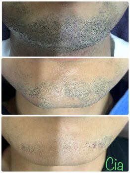シア 静岡店(cia)/【ヒゲ脱毛】