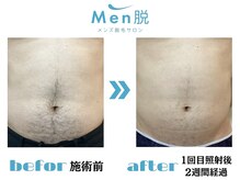 メン脱(Men脱)/★ビフォーアフター★