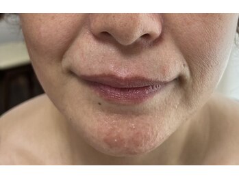 ピュアージュ/神業エイジング▼輪郭/後