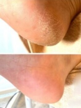 チェリー(Cherry)の写真/【痛みの少ない磨き上げる足裏角質ケア】かかとのがさつき・ごわつきが気になる季節は、プロがお悩み解消♪