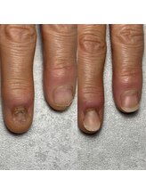 トレフル(Trefle)/深爪矯正/初回で人に出せる爪へ